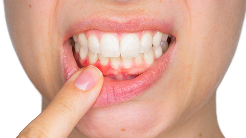Viêm lợi có gây rụng răng?