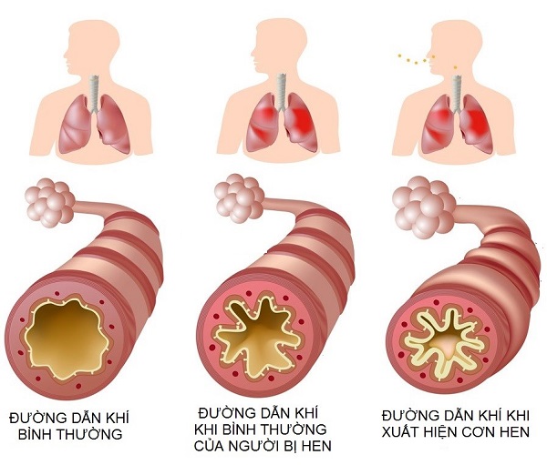 Cách kiểm soát bệnh hen suyễn hiệu quả