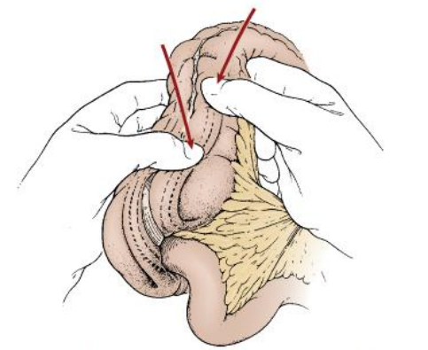 Người lớn cũng có thể bị lồng ruột