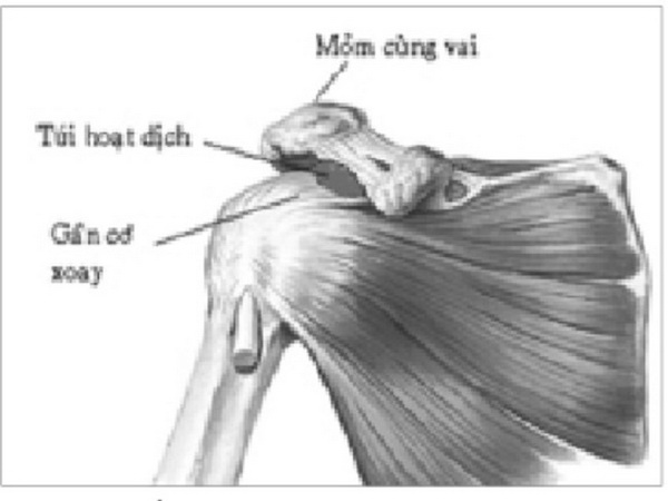 Hội chứng chèn ép dưới mỏm cùng vai là một nguyên nhân gây đau quanh vai.