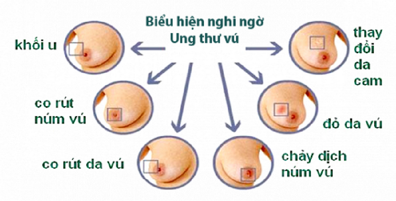 Dấu hiệu nghi ngờ ung thư vú.