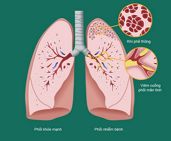 Viêm phổi tắc nghẽn mạn tính (COPD) đang trở thành gánh nặng về y tế trên toàn cầu.