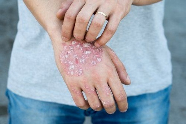 Bệnh chàm gây ảnh hưởng tới thẩm mỹ và sinh hoạt của người bệnh.   
