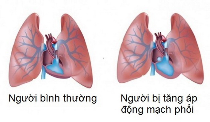 Tăng áp động mạch phổi và những lưu ý