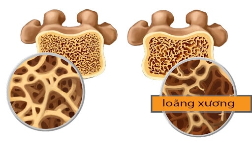 Nhận biết sớm bệnh loãng xương