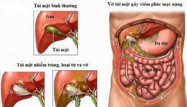 Hình ảnh viêm phúc mạc do vỡ túi mật.