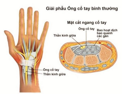 Dây thần kinh giữa bị chèn ép sẽ dẫn đến hội chứng ồng cổ tay.