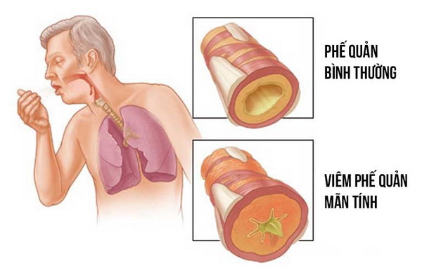 Ho là triệu chứng thường gặp trong bệnhviêm phế quản.