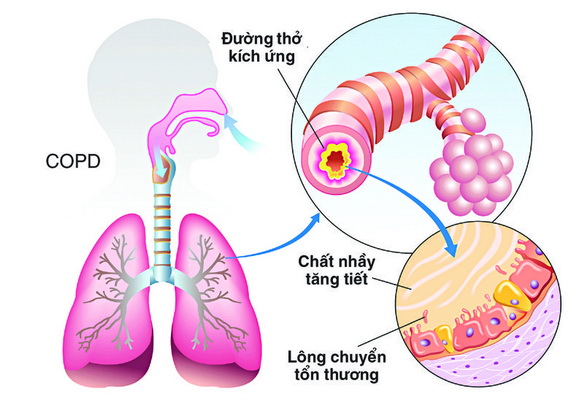 Bệnh COPD ảnh hưởng nhiều tới chất lượng cuộc sống của người bệnh.
