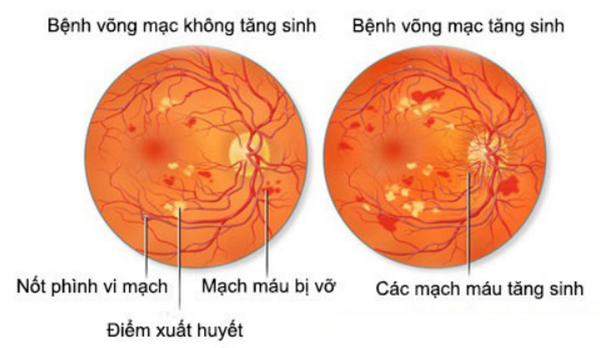 Bệnh VMĐTĐ xảy ra hầu hết ở các trường hợp ĐTĐ tiến triển sau 10-15 năm.