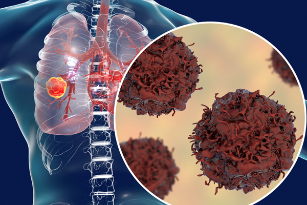 75% ung thư phổi không sớm phát hiện được, vì sao?