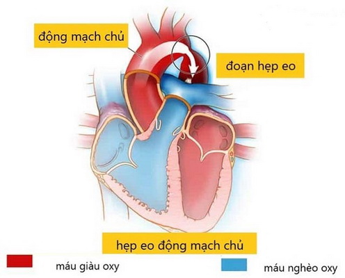 Hình ảnh hẹp eo động mạch chủ.