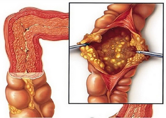 Các bệnh lý thường gặp liên quan đến ruột non