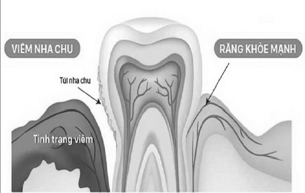Chảy máu chân răng có thể gây mất răng