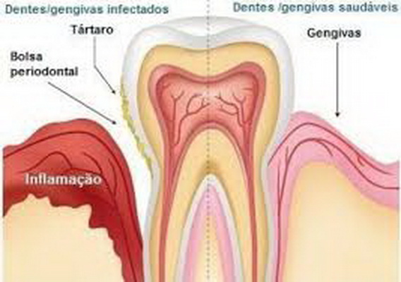 Nguyên nhân thường gặp gây chảy máu miệng và cách xử trí tại nhà- Ảnh 2.