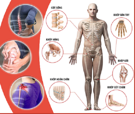 Các khớp dễ bị tổn thương.