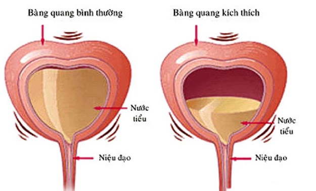 Bàng quang tăng hoạt.