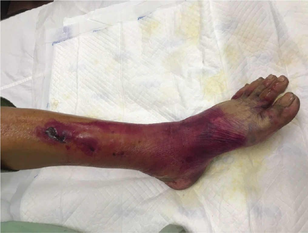 Ảnh hưởng lên da của bệnh đái tháo đường, dấu hiệu không nên bỏ qua- Ảnh 2. Suýt mất chân vì sốc nhiễm trùng da