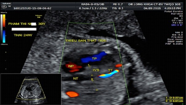 Một ca thiểu sản tâm thất trái phát hiện ở thai nhi 24 tuần tuổi tại BV TƯQĐ 108.