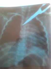 Hình ảnh cây kéo đâm xuyên ngực bệnh nhi trên phim Xquang.