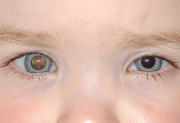 Đốm trắng trong mắt có thể là dấu hiệu của bệnh ung thư ở mắt