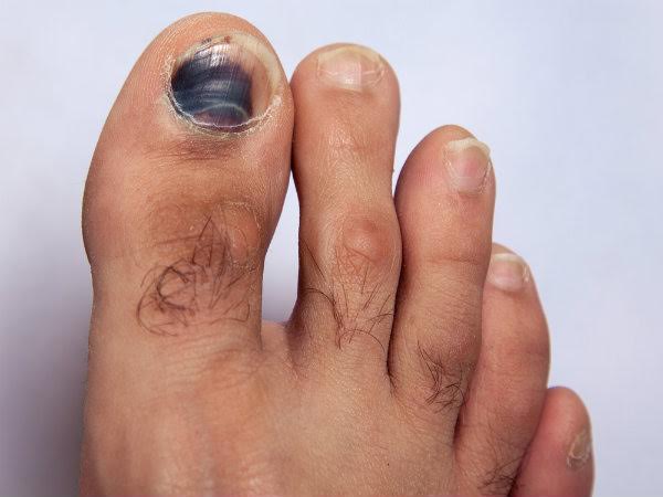 9 triệu chứng ở móng - Sức khỏe móng chân: Móng chân không chỉ là \