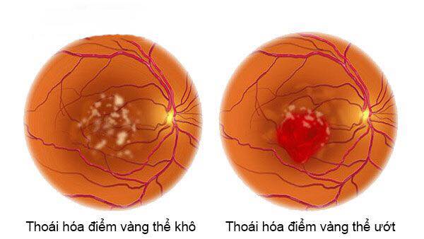 Quản lý và theo dõi bệnh thoái hóa hoàng điểm tuổi già như thế nào?