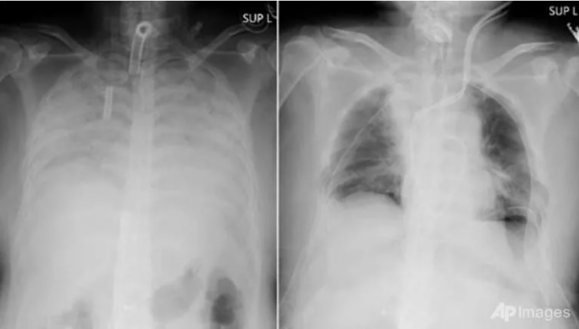 Bệnh nhân COVID-19 đầu tiên được ghép phổi từ người hiến tặng còn sống