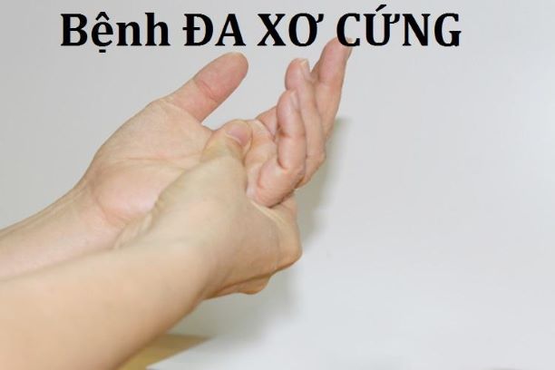 Rituximab hiệu quả và an toàn hơn đối với bệnh nhân đa xơ cứng