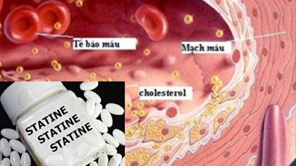 Statin có thể làm giảm nguy cơ ung thư đại trực tràng