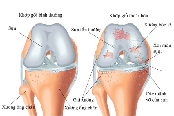 Trí tuệ nhân tạo giúp phát hiện thoái hóa khớp sớm hơn