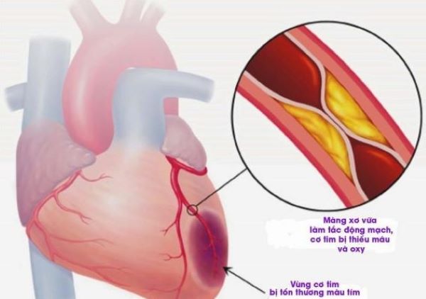 Ngay cả dùng steroid ở liều thấp vẫn làm tăng nguy cơ mắc bệnh tim mạch