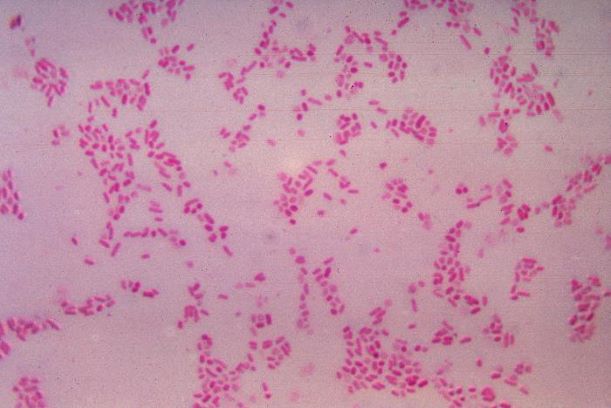 Vi khuẩn Bacteroides fragilis có nguy cơ gây ung thư vú