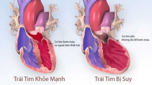 Thuốc dapagliflozin làm giảm biến cố suy tim
