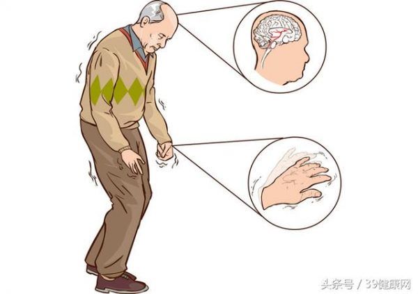 Liệu pháp mới giúp cải thiện chất lượng sống cho bệnh nhân Parkinson