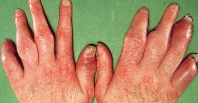 Phương pháp mới điều trị bệnh viêm khớp vảy nến