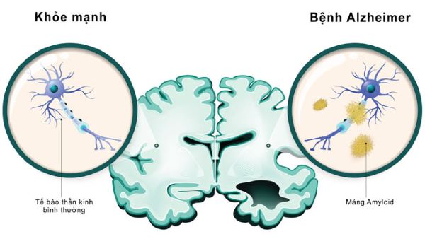 não của bệnh nhân Alzheimer