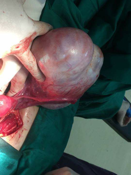 BV E bóc tách thành công khối u nhầy buồng trứng khổng lồ nặng 1,8 kg 