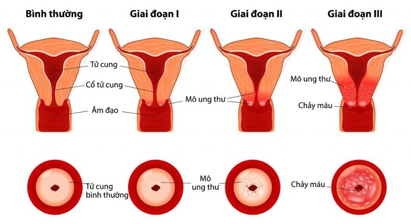 4. Điều trị cổ tử cung chữ Y