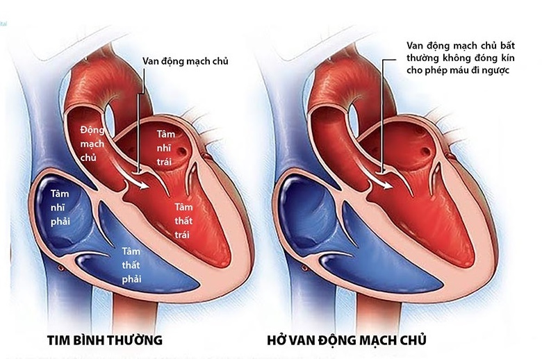 Hở van động mạch chủ có cần mổ ?