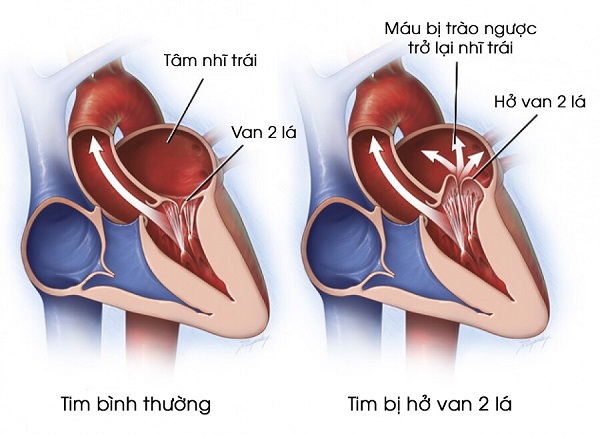 Bị Hở Van Tim Có Nguy Hiểm Không? Nguyên Nhân, Triệu Chứng và Điều Trị