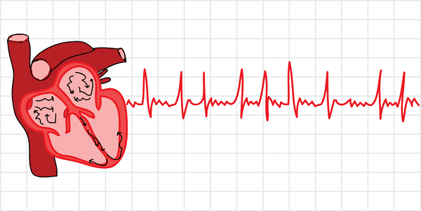 Hở van tim 2 lá 2/4 có thể tiến triển nặng nếu không xử lý sớm