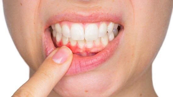 Cảnh báo: Những bệnh tật liên quan đến răng nướu
