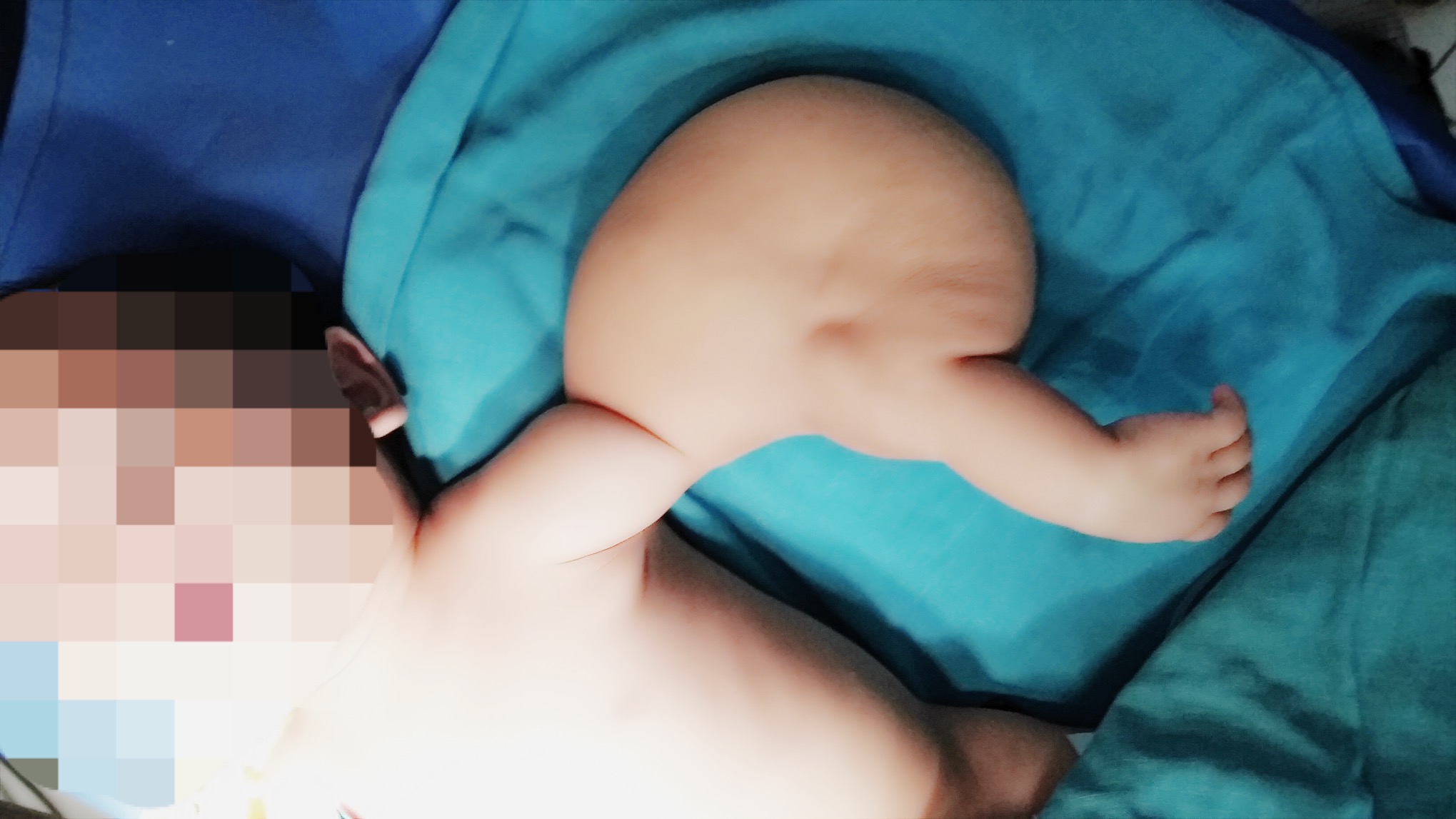 Các biến chứng của u nang bạch huyết ở trẻ em- Ảnh 2.