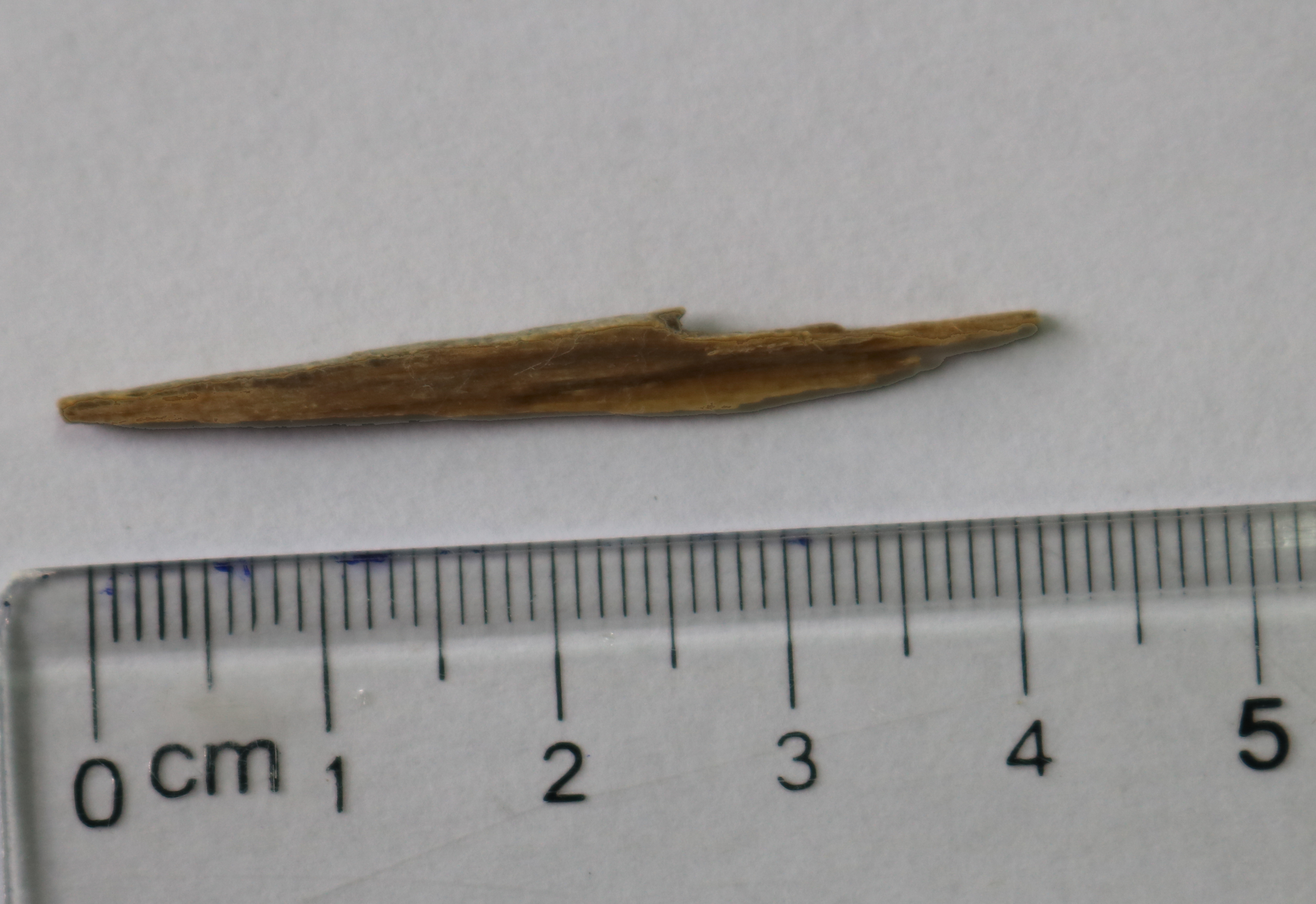 Mảnh gỗ dài 4,5 cm nằm 8 tháng trong cổ của người bệnh