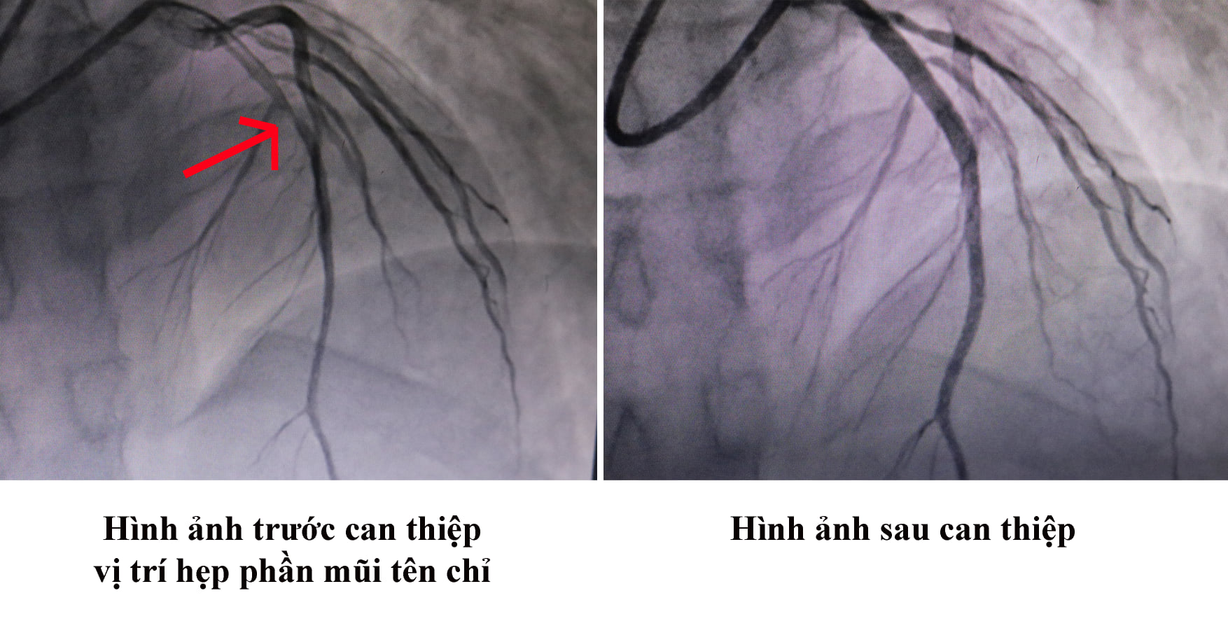 Thanh niên 31 tuổi bị nhồi máu cơ tim cấp, lời cảnh tỉnh nào cho giới trẻ?