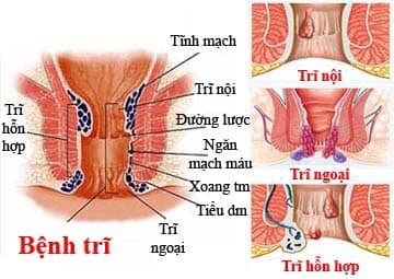 Biện Pháp Điều Trị Khi Bị Nhiễm Trùng