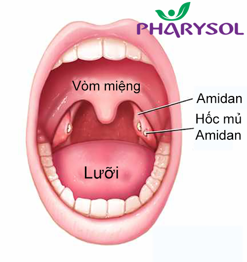 3 vấn đề quan trọng người bị viêm amidan cần biết !