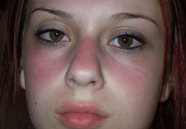 Lupus ban đỏ - Mối hiểm họa khôn lường