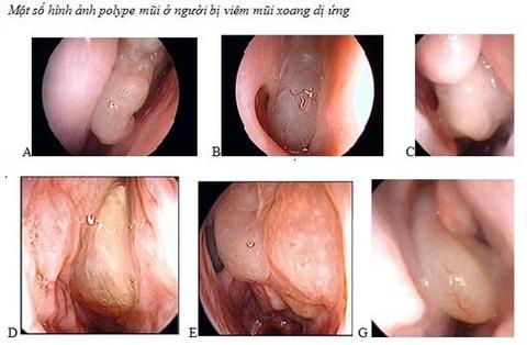 Biến chứng của bệnh viêm mũi dị ứng